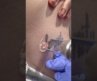 Laser tattoo removal. Could you do this without numbing? #shorts