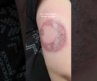 the day I got the tattoo and then 7 laser tattoo removal sessions later. tattoo update!