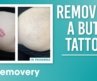 Removing a Butt Cheek Tattoo | Motivation Monday