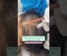 {2024 } PRP – Best hair loss treatment for females #shorts