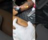 Laser Tattoo Removal 💥only 500/-💸🥳 | Ujjain📍| 9516362594☎️